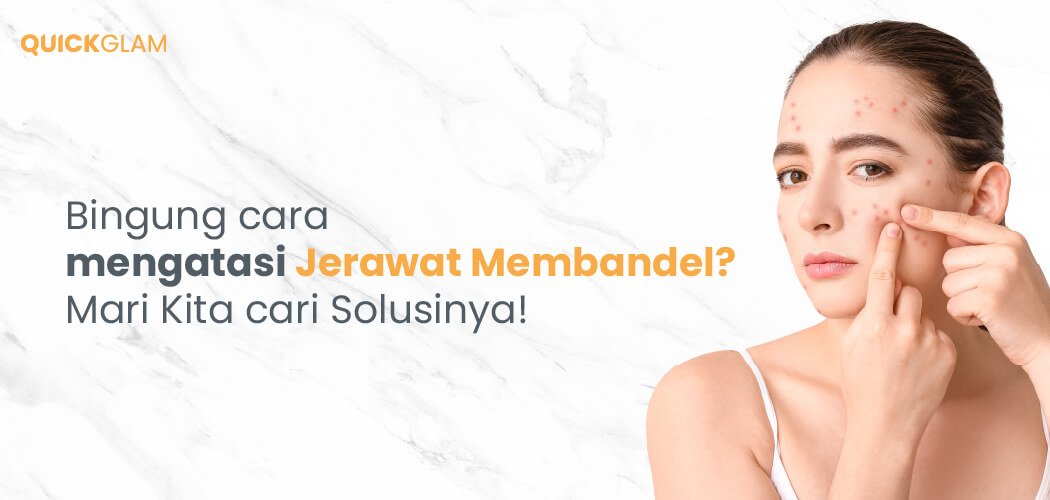 Cara mengatasi Jerawat Membandel
