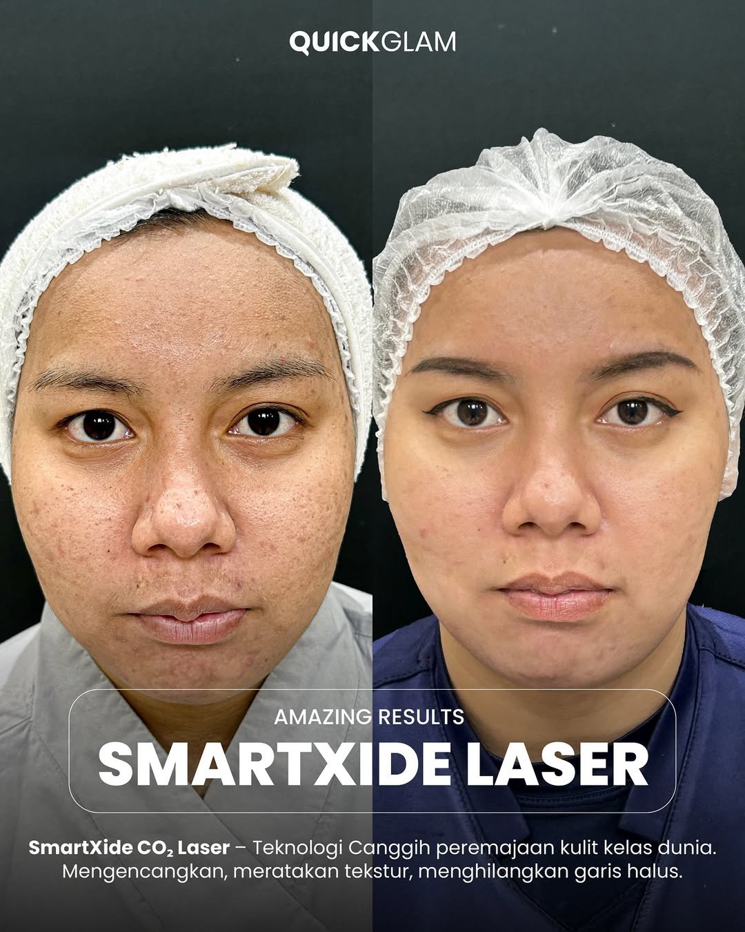 Dari kulit bertekstur jadi halus & glowing! ✨Bekas jerawat scar, pori-pori besar, dan garis halu