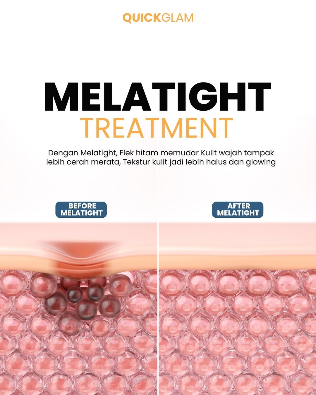 Flek hitam & melasma Tenang, ada solusinya!Melatight Treatment dari Quickglam bantu memudarkan n
