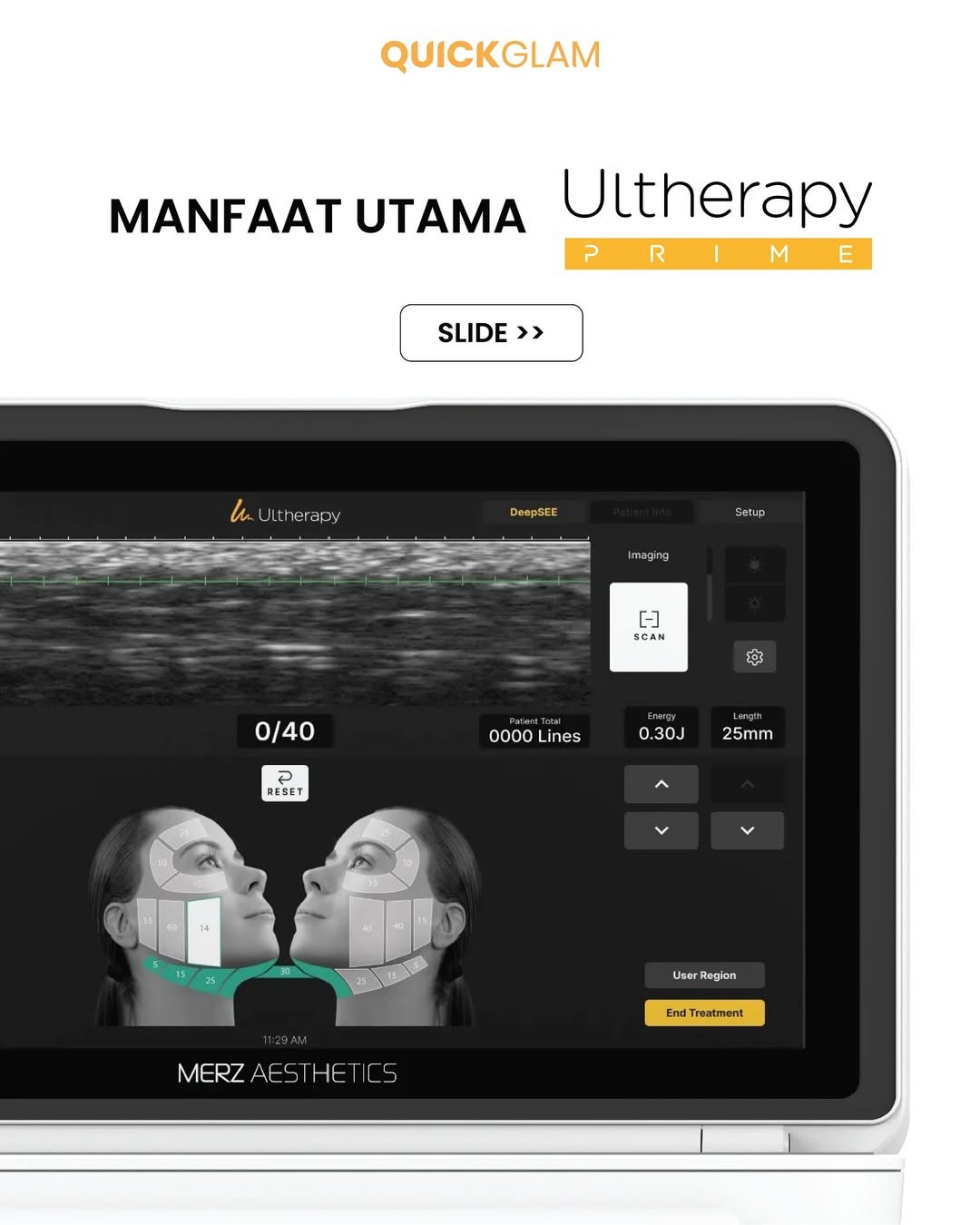 Ultherapy Prime treatment yang sangat direkomendasikan usia 30–50anyang mulai merasa kulit menur
