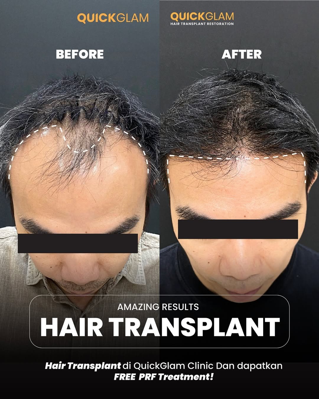 ❌ Rambut tipis & hairline mundur bikin nggak pede✅ Saatnya balikin rambut dan rasa percaya diri