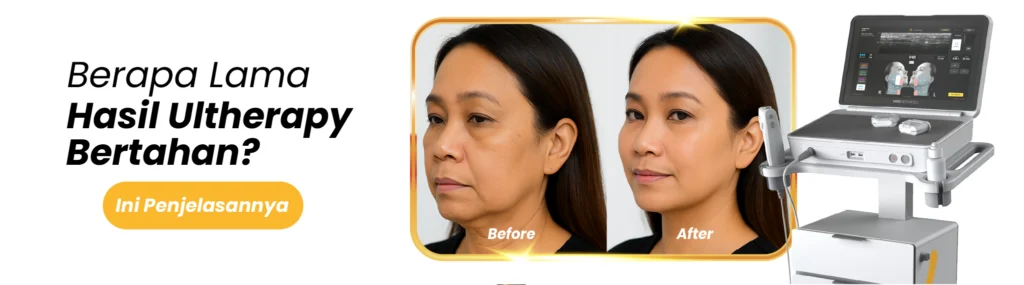 12 - Berapa Lama Hasil Ultherapy