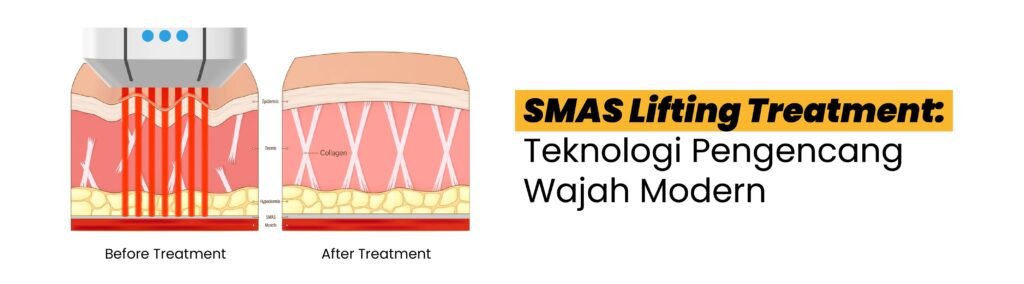 22 - SMAS Lifting Treatment
