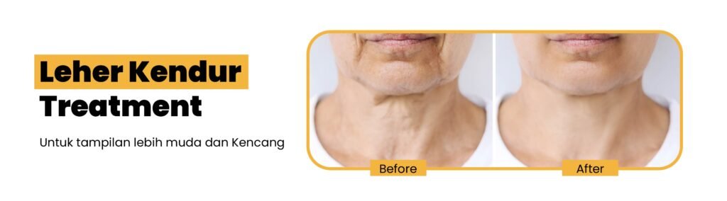 25 - Treatment Leher Kendur