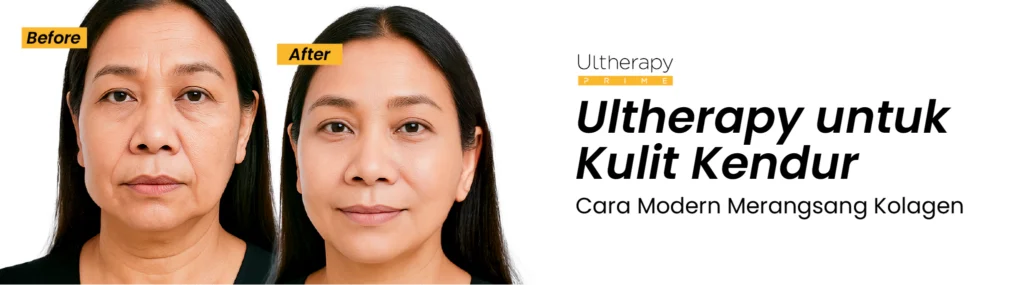 8 - Ultherapy untuk Kulit Kendur